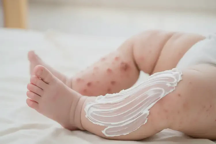 寶寶大腿容易起濕疹不管它會自己痊愈嗎(圖2)