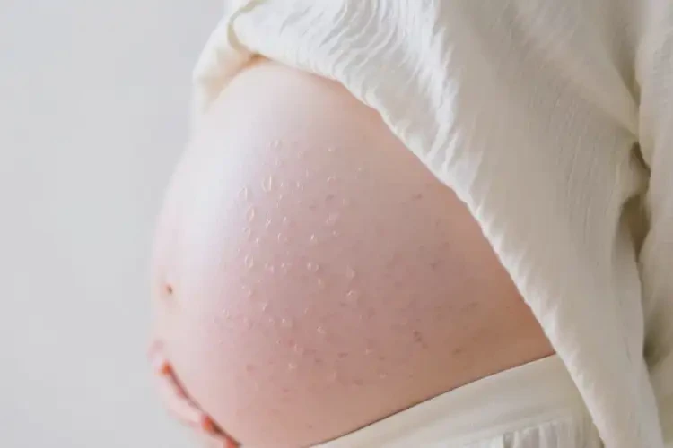 孕婦身上經(jīng)常長(zhǎng)濕疹能靠自己自愈嗎(圖3)