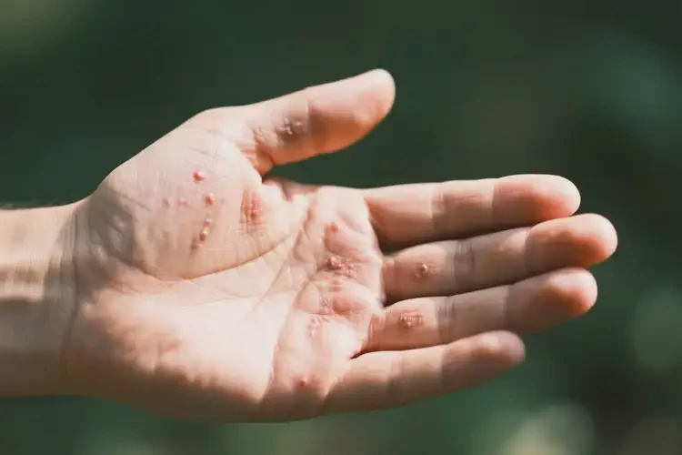 男性手上偶爾長(zhǎng)濕疹不管它會(huì)自己好嗎(圖3)