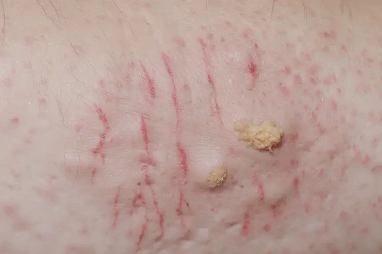 老年人腳上出現(xiàn)濕疹可不可以徹底自愈(圖3)