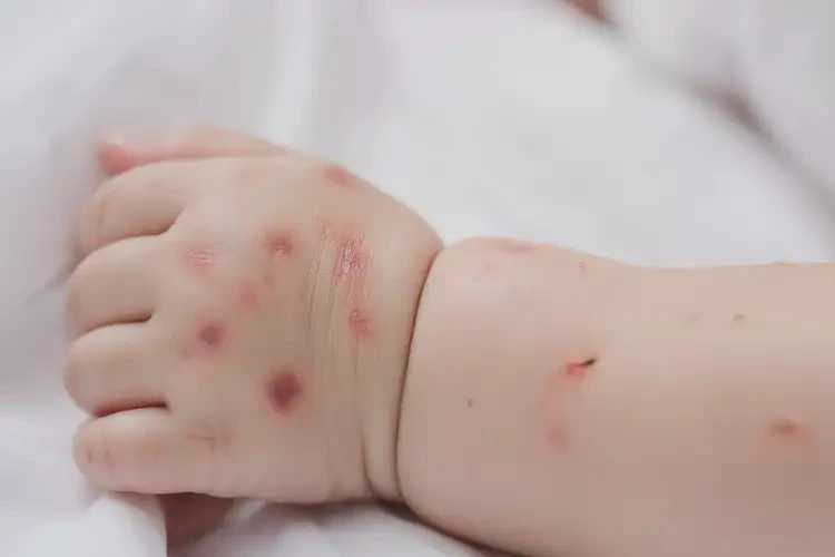 寶寶手上長濕疹能夠徹底治愈嗎(圖4)