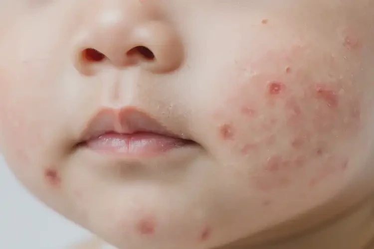 幼兒臉上經常起濕疹不管它會自己痊愈嗎(圖4)