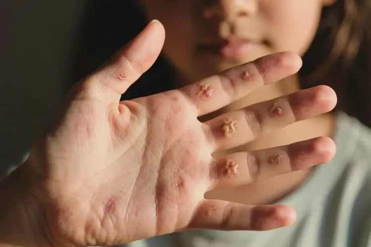 女生手上有濕疹可不可以徹底自愈(圖3)