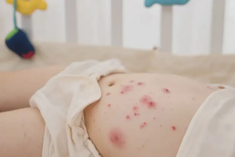 幼兒肚子偶爾起濕疹不管它會自己痊愈嗎(圖3)