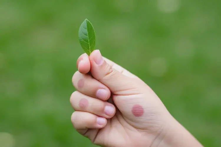 幼兒手上經(jīng)常長濕疹不管它會自己自愈嗎(圖2)