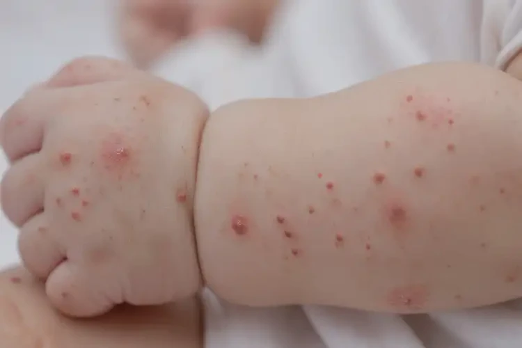 宝宝手臂出湿疹不管它会自己好吗(图3)