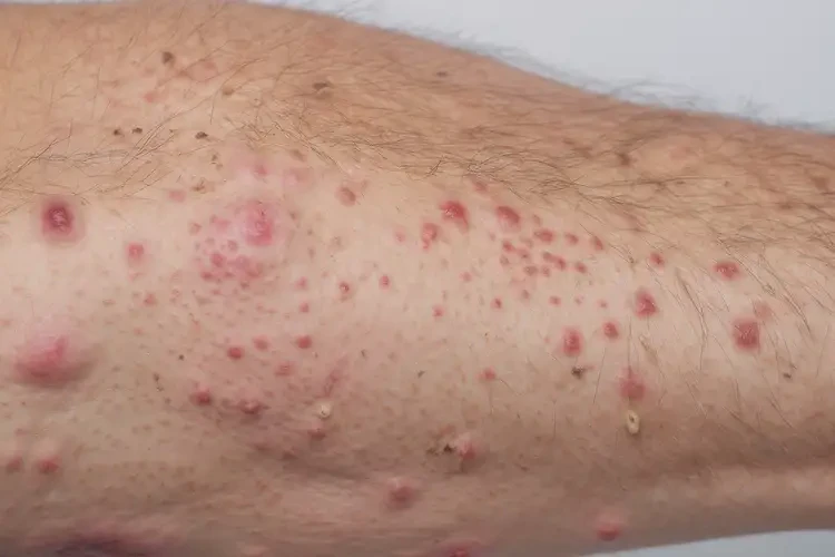 男人全身容易長濕疹不管它會(huì)自己好嗎(圖4)