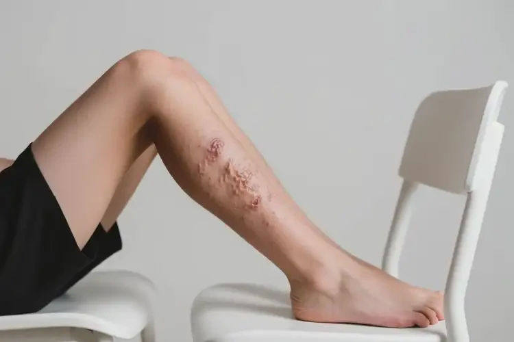 中學(xué)生大腿上起濕疹能靠自己自愈嗎(圖3)