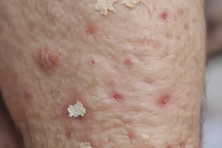 高齡老人小腿出現(xiàn)濕疹不管它會自己自愈嗎(圖4)