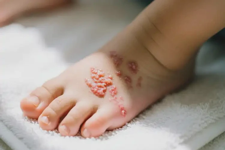 小孩腳上偶爾起濕疹不管它會自己好嗎(圖4)