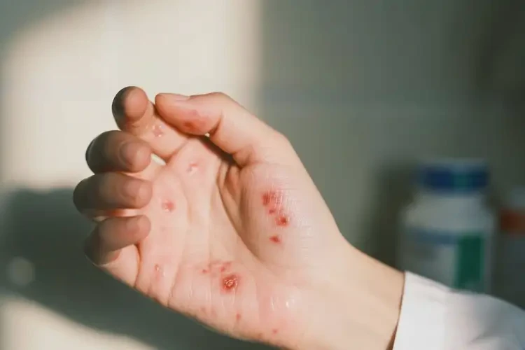 青年人手上有濕疹不管它會自己好嗎(圖3)