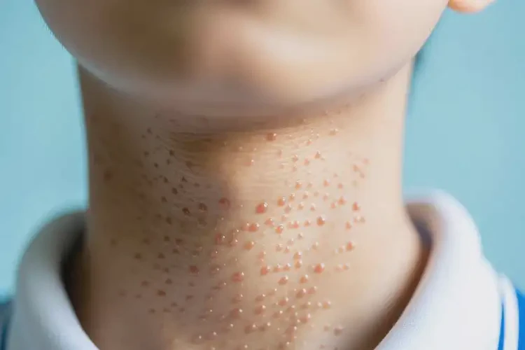 中學(xué)生脖子上長濕疹能不能徹底自愈(圖1)