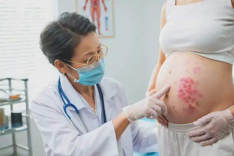 孕婦肚子偶爾長濕疹不管它會自己痊愈嗎(圖2)