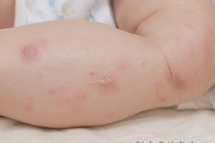 嬰幼兒大腿起濕疹能夠徹底治愈嗎(圖2)