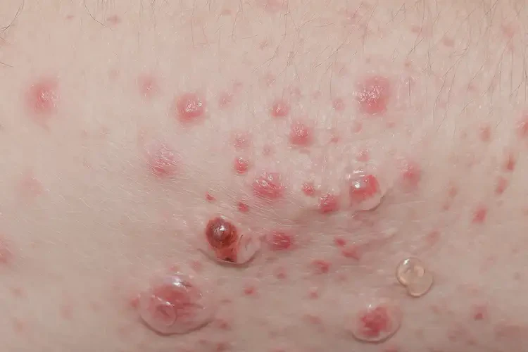 男生身上出濕疹能靠自己自愈嗎(圖4)