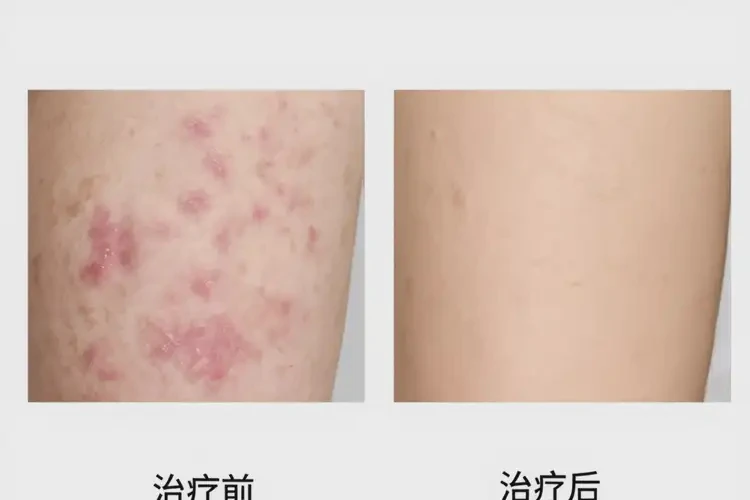 青年人肛周偶爾長(zhǎng)濕疹能夠徹底治愈嗎(圖3)