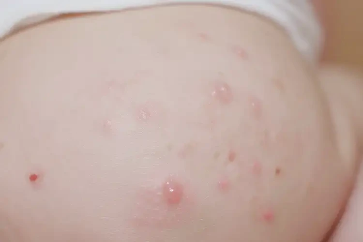 嬰兒屁股上出現(xiàn)濕疹能靠自己自愈嗎(圖4)