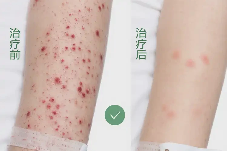 產(chǎn)婦屁股上出現(xiàn)濕疹不管它會自己好嗎