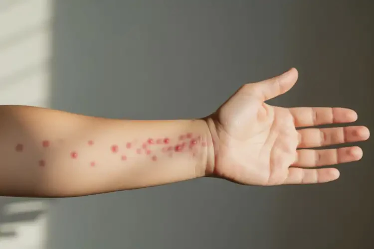 女生手臂上有濕疹不管它會自己痊愈嗎(圖2)