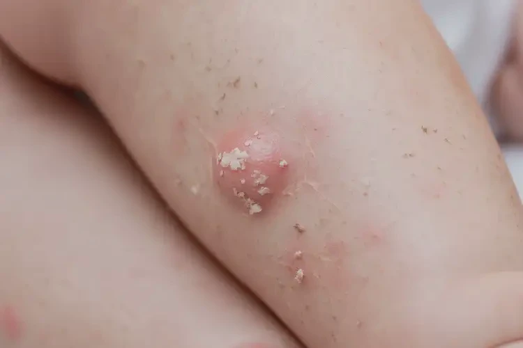 寶寶小腿長濕疹能徹底自愈嗎(圖4)