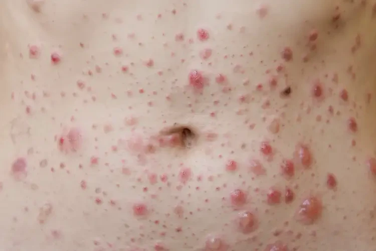 女人肚子經(jīng)常起濕疹不管它會自己痊愈嗎(圖4)