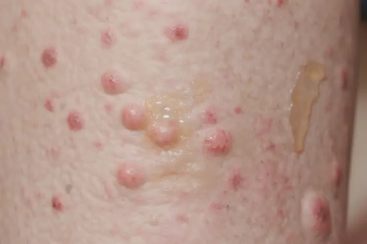 青少年大腿上偶爾起濕疹能靠自己自愈嗎(圖3)