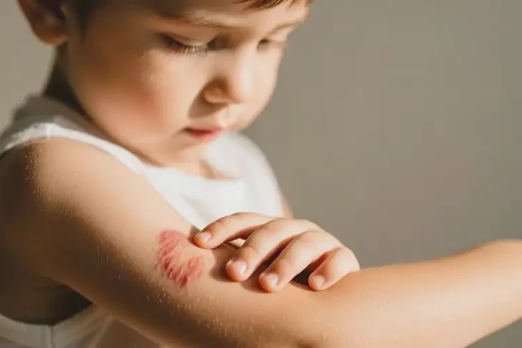 小孩四肢容易起濕疹能徹底自愈嗎(圖1)