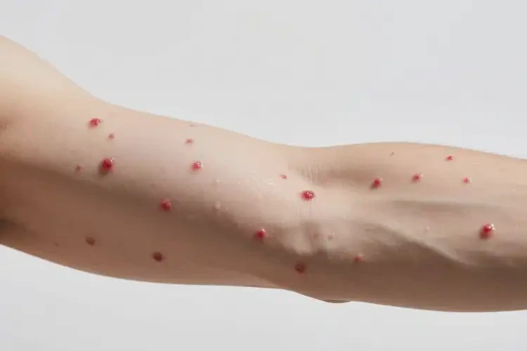 男性手臂偶爾長濕疹不管它會自己痊愈嗎