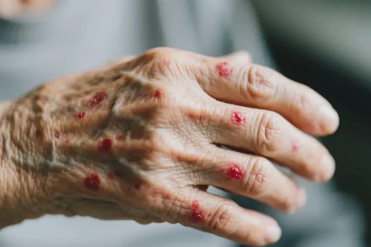 老人身上偶爾長濕疹能夠徹底治愈嗎(圖4)
