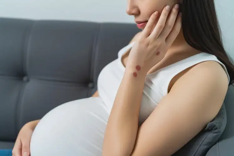 孕婦身上經(jīng)常長(zhǎng)濕疹能靠自己自愈嗎(圖2)