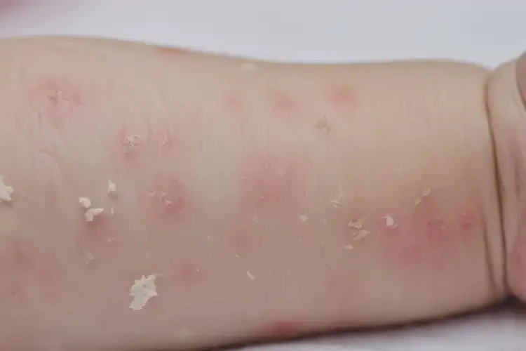 嬰幼兒身上有濕疹可不可以徹底自愈(圖4)