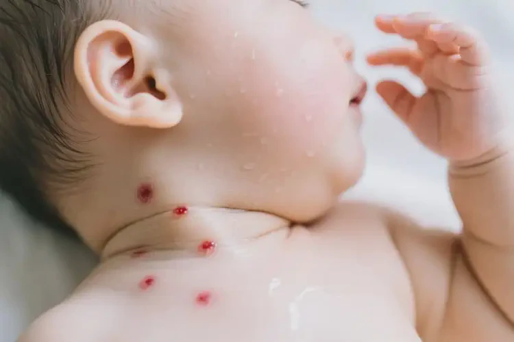 寶寶脖子上出濕疹可以徹底自愈嗎(圖3)