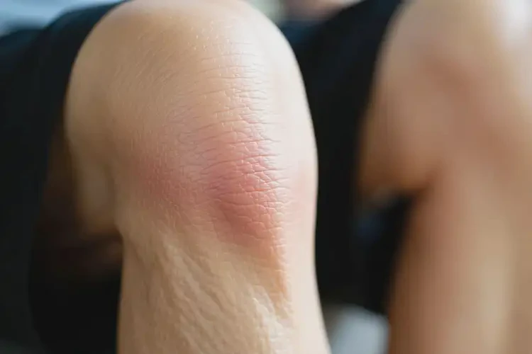 老人小腿上偶爾起濕疹不管它會(huì)自己自愈嗎(圖3)