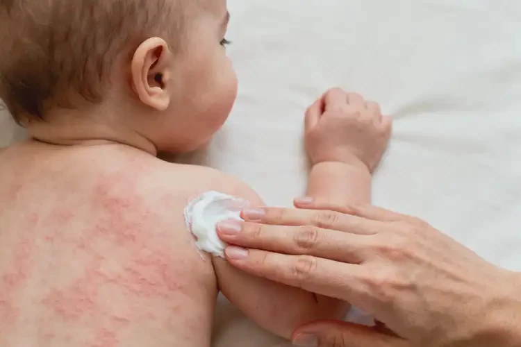 嬰兒全身容易長(zhǎng)濕疹不管它會(huì)自己痊愈嗎(圖1)