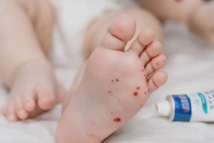 嬰兒腳上出濕疹不管它會(huì)自己自愈嗎(圖4)