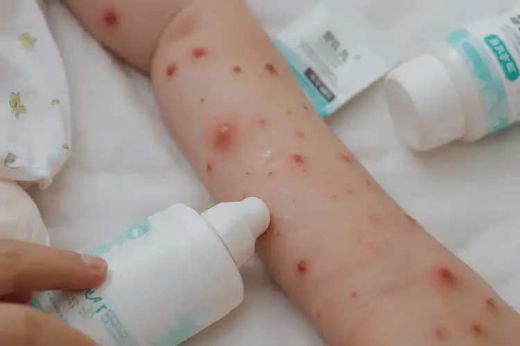 新生兒手臂上出濕疹能夠徹底治愈嗎(圖4)