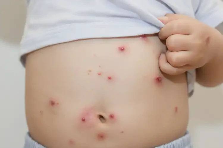 小兒肚子長濕疹不管它會(huì)自己好嗎(圖4)