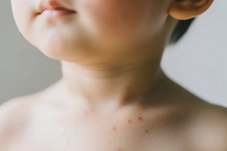 小孩脖子上偶尔长湿疹可不可以彻底自愈(图1)