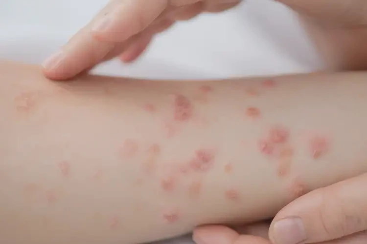 產(chǎn)婦手臂上經(jīng)常起濕疹能夠徹底治愈嗎(圖4)