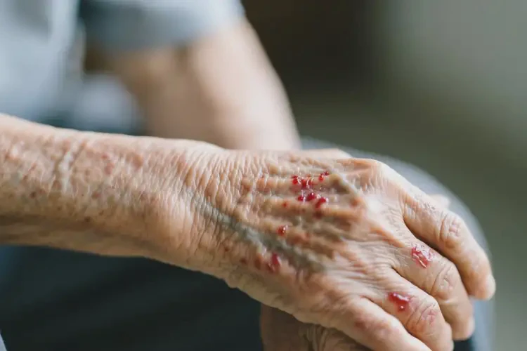 高齡老人手臂上出濕疹能徹底自愈嗎(圖4)
