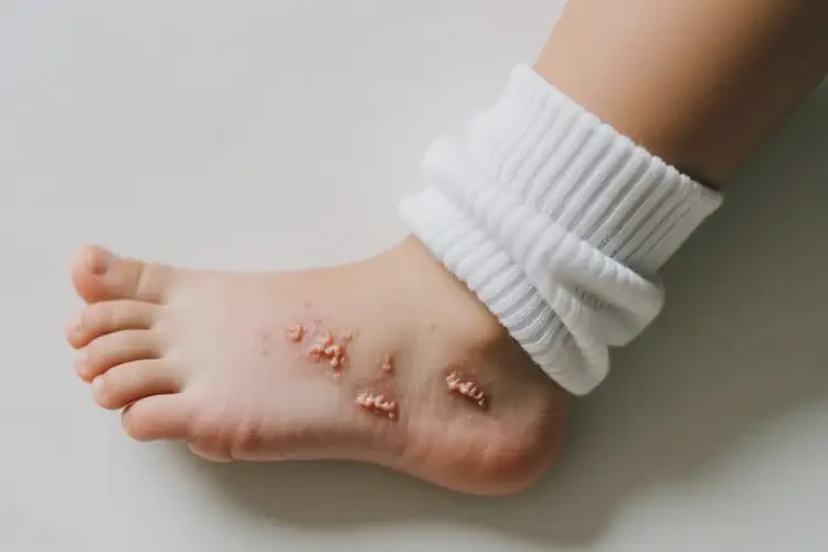 小孩腳上偶爾起濕疹不管它會自己好嗎(圖2)