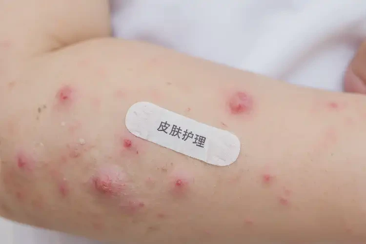 孩子手臂出現(xiàn)濕疹能徹底自愈嗎(圖4)
