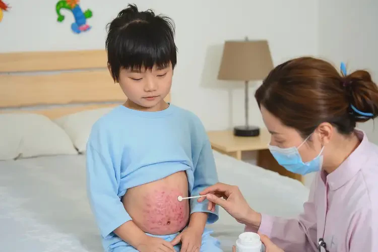 小兒肚子長濕疹不管它會(huì)自己好嗎(圖1)