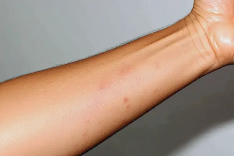 孕婦手臂出現(xiàn)濕疹可以徹底自愈嗎(圖2)