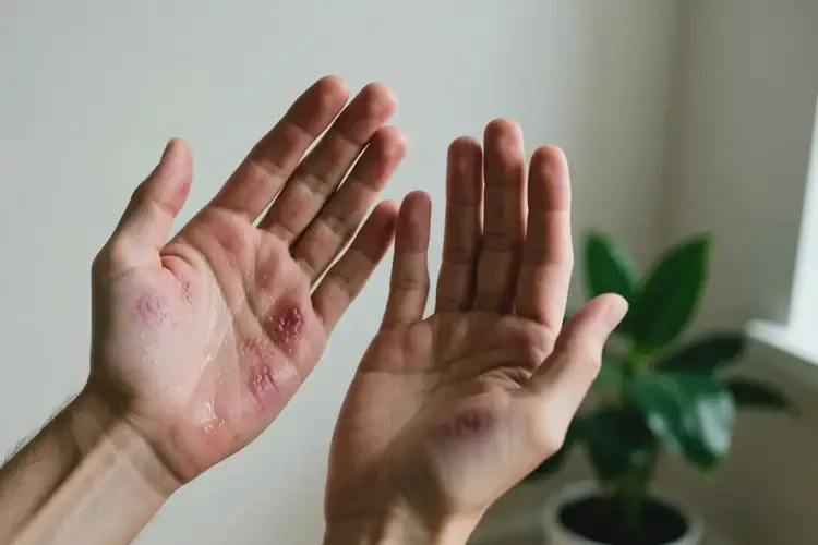 青年人手上有濕疹不管它會自己好嗎(圖4)