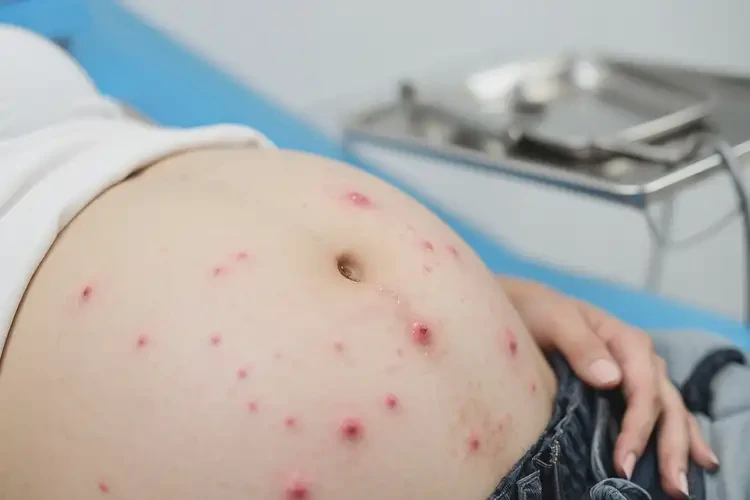 孕婦肛周偶爾長(zhǎng)濕疹可不可以徹底自愈(圖4)