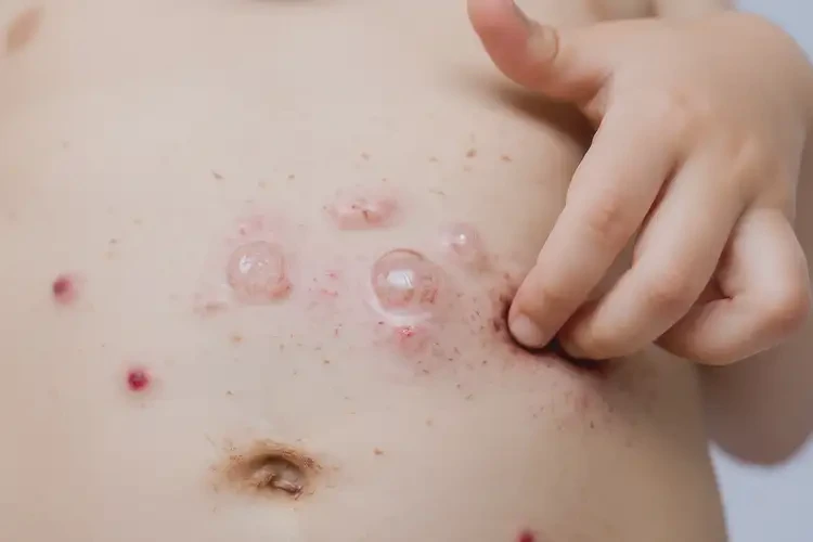 小兒肚子偶爾起濕疹不管它會自己痊愈嗎(圖3)