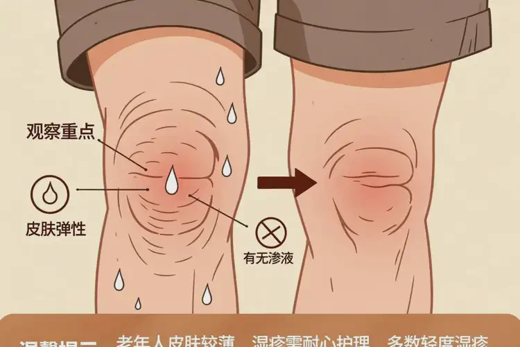 老年人大腿偶爾長濕疹不管它會自己痊愈嗎(圖1)