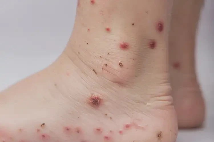 小學(xué)生腳上偶爾長(zhǎng)濕疹可不可以徹底自愈(圖4)