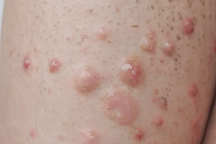 產(chǎn)婦小腿上起濕疹不管它會(huì)自己自愈嗎(圖4)